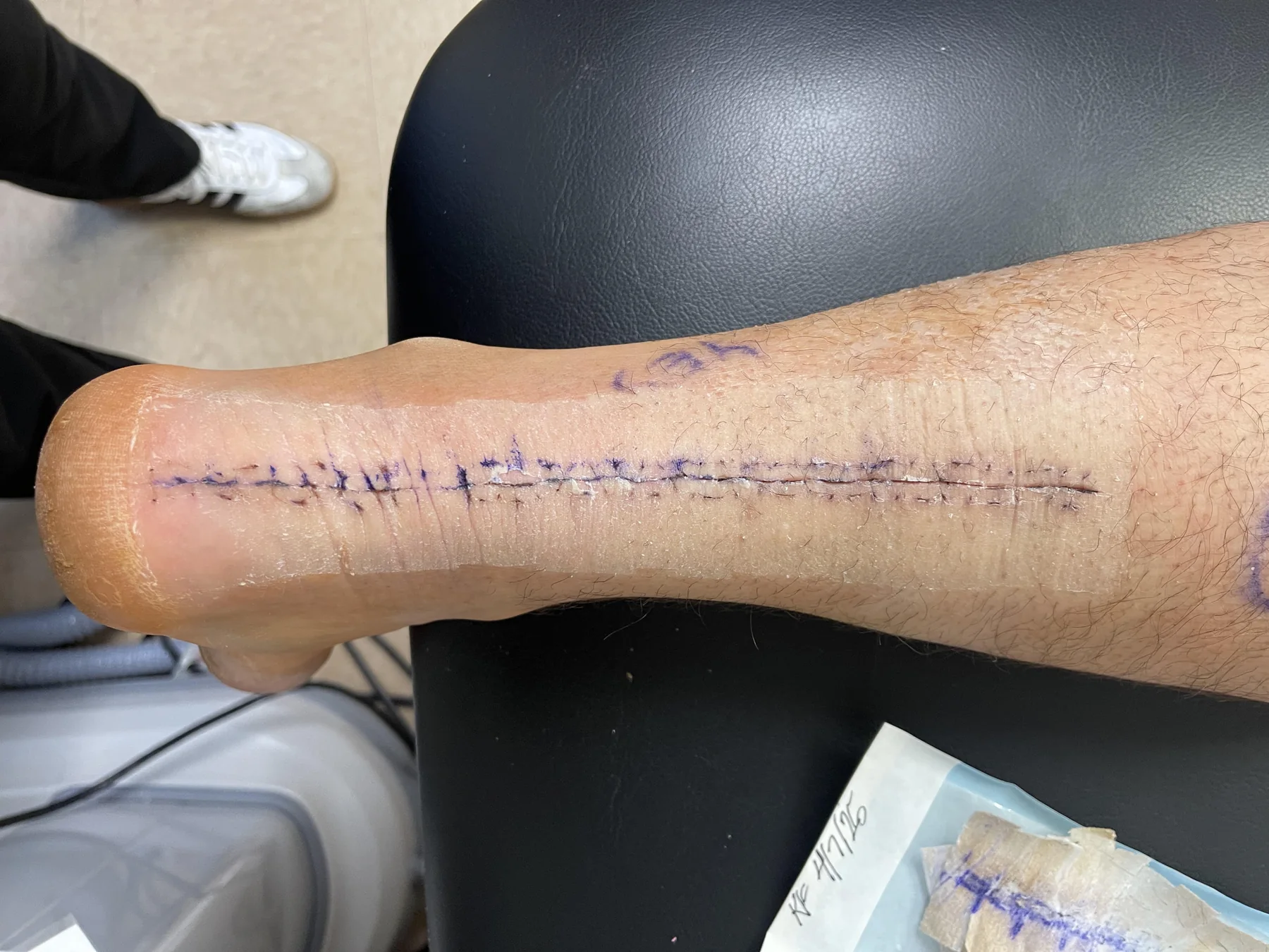 Coach H's Achilles incision during post-operative recovery
